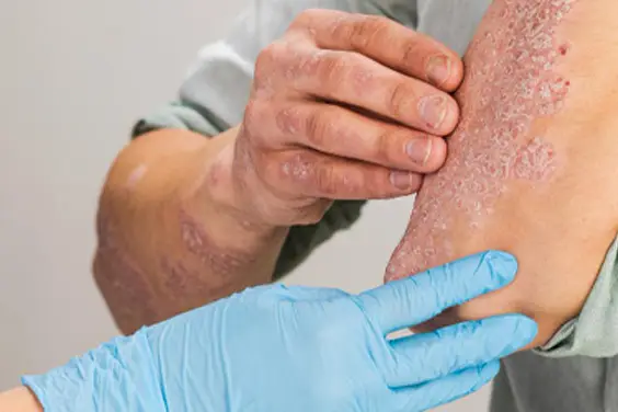 psoriasis treatment